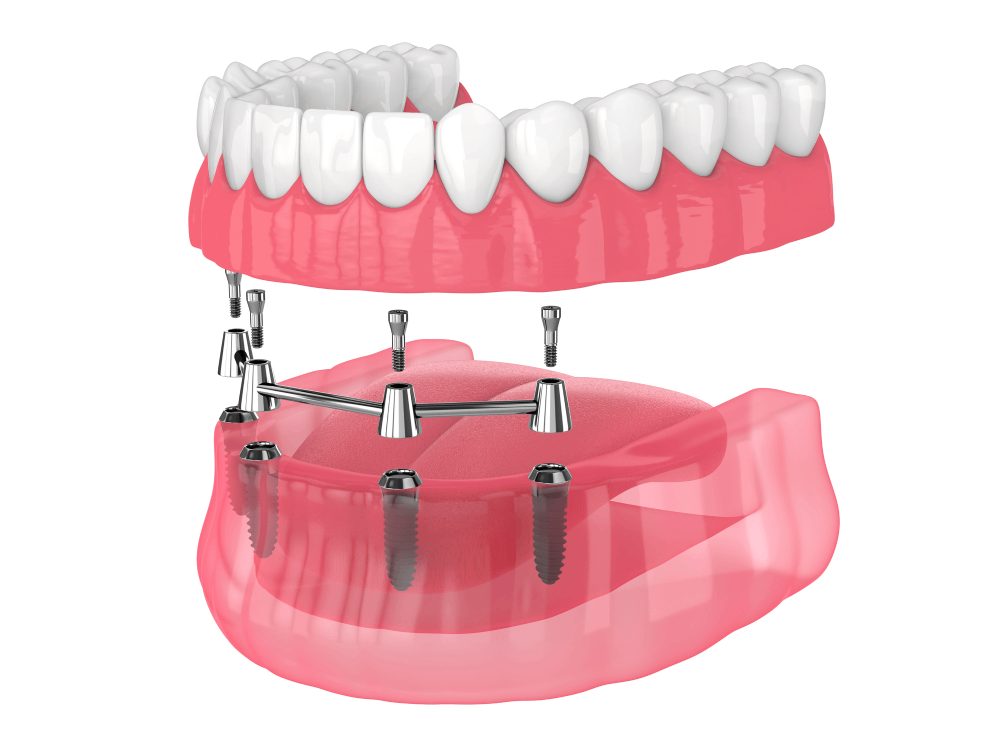 Full-Mouth Dental Implants