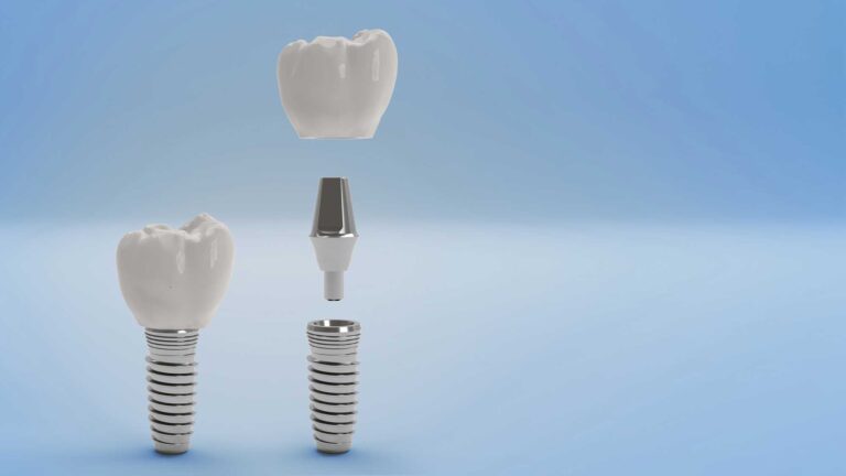 An illustration showcases the components of a dental implant: the implant screw, the abutment, and the crown. The image visually explains how the abutment connects the implant screw, which is embedded in the jawbone, to the crown that restores the tooth’s function and appearance.