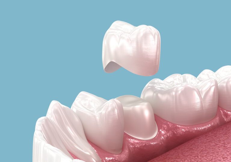 An illustration depicts a dental crown being placed over a prepared tooth, with the surrounding gum tissue visible. The crown appears smooth, white, and properly aligned, showcasing the process of restoring a tooth’s shape, size, and function.